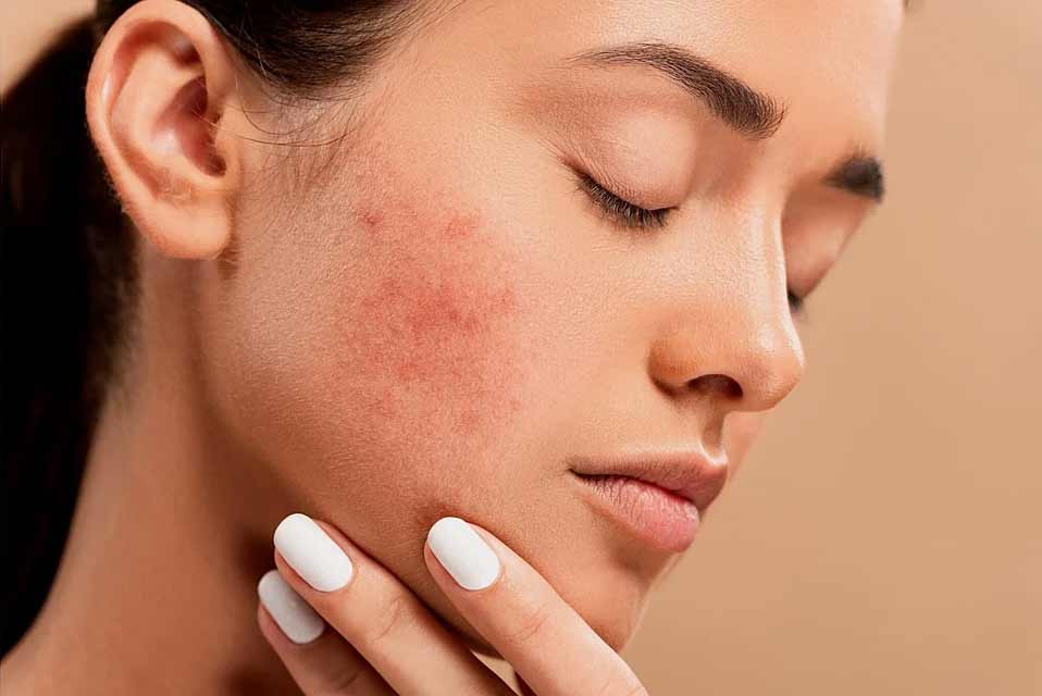 Acne Treatment Cost In Hyderabad